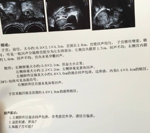 子宫内膜异位症 b超，子宫内膜异位症b超报告